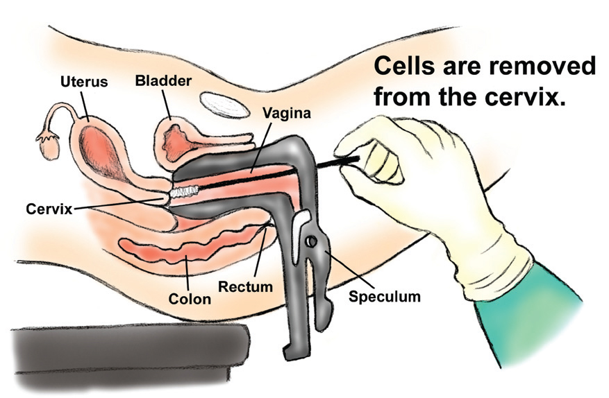 Abnormal Pap Smear Means