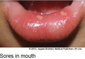 Sores in Mouth